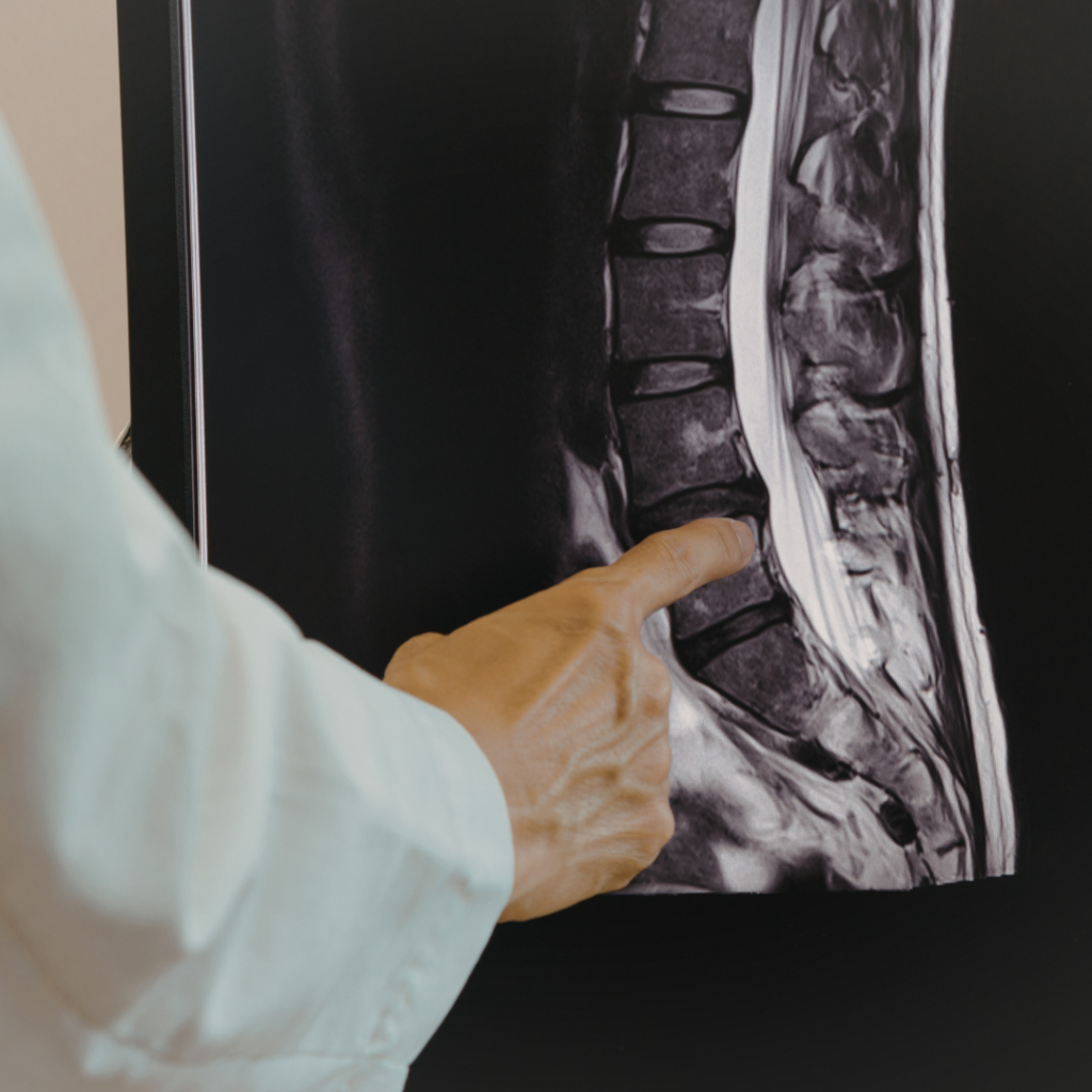 Spinal Cap Fraud Exposed: $500M Kickback Scheme in California Workers’ Comp