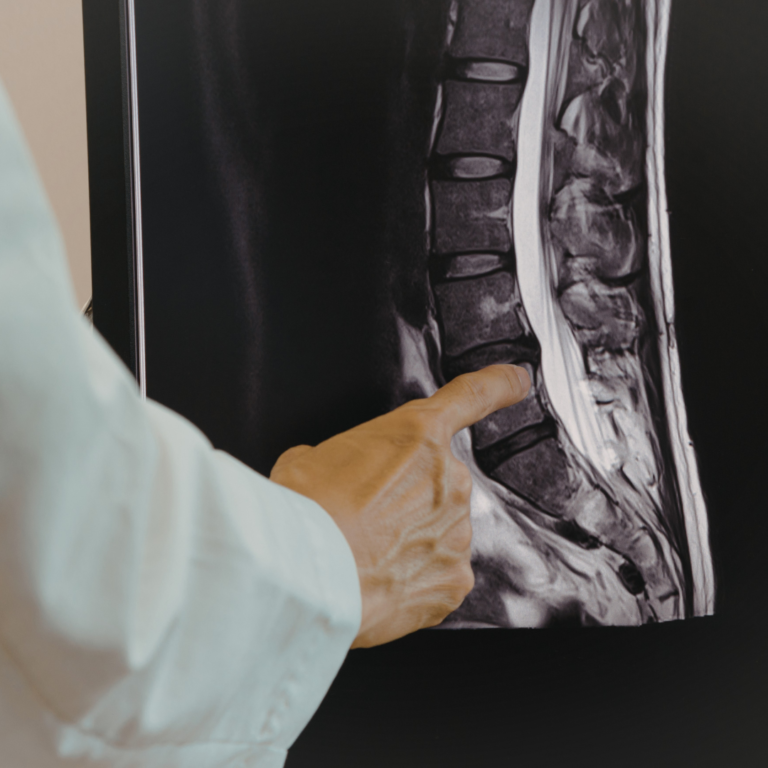 Spinal Cap Fraud Exposed: $500M Kickback Scheme in California Workers’ Comp
